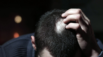 Desperate Young Man Touch His Bald Patches - obrazy, fototapety, plakaty