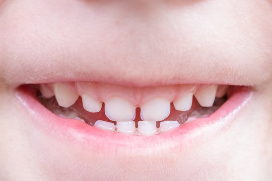 Schneidez&auml;hne und Eckz&auml;hne eines Milchgebisses eines kleinen Jungen