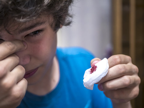 close up face of teenager with bleeding blood from nose