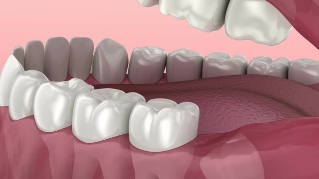 Wisdom tooth problem. Medically accurate tooth 3D animation