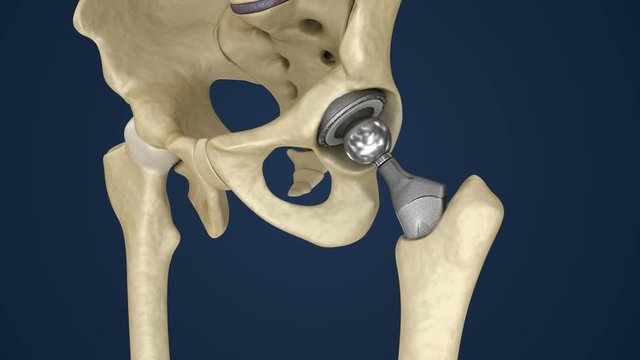Hip replacement implant installed in the pelvis bone. Medically accurate 3D animation