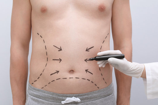 Doctor drawing lines on man's stomach with marker against light background
