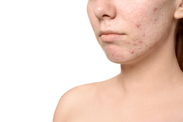 Young woman with acne problem on white background