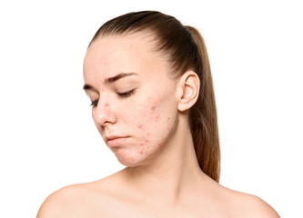 Young woman with acne problem on white background