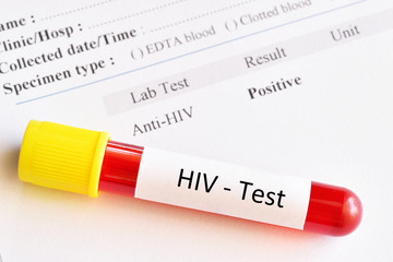 Obraz premium HIV positive test result with blood sample tube 