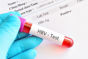 Hepatitis B virus positive test result with blood sample tube