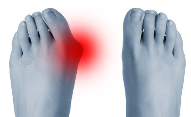 Feet before and after surgical correction of hallux valgus