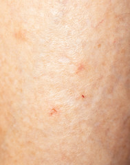 Naklejka premium mosquito bites on the leg
