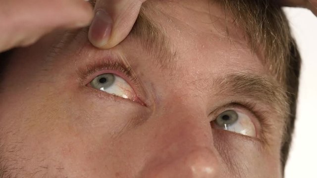 hordeolum disease in the eye, man dripping treatment drops to his eye. infection and inflamnmation of eye. 4K