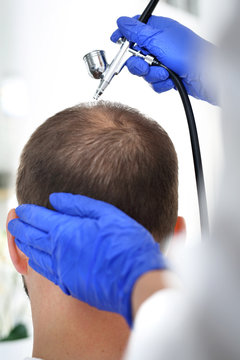 Tlenoterapia sk&oacute;ry głowyGłowa mężczyzny z przerzedzonymi włosami podczas zabiegu pielęgnacyjnego i mieszk&oacute;w włosowych. 
