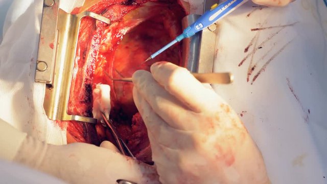 Cautery of damaged part of surgical field near the heart.
