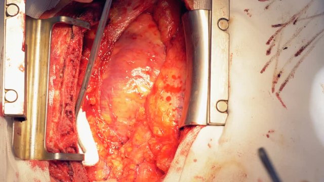 The process of coagulation for blood vessels near the heart. 