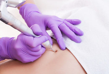 Obraz na płótnie Canvas Removal of benign tumors in Cosmetic salon. The use of liquid nitrogen in dermatology.