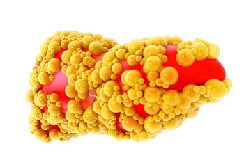 Human liver cirrhosis