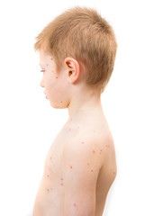 Naklejka premium child with varicella