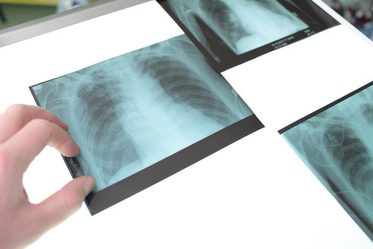 Series of X-ray images on X-ray viewer in the staffroom