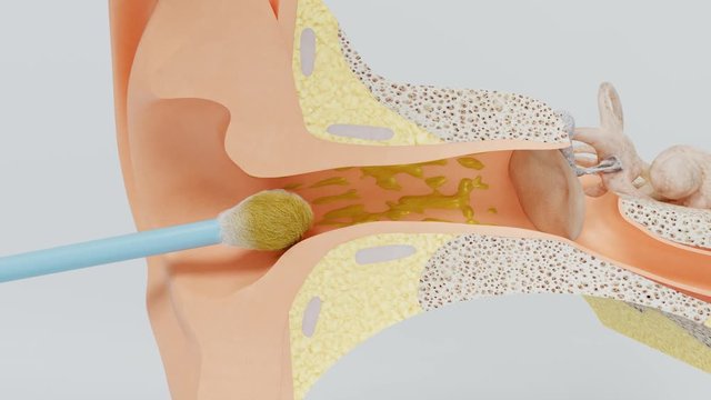 Right way of using cotton swab. Ear wax cleaning.