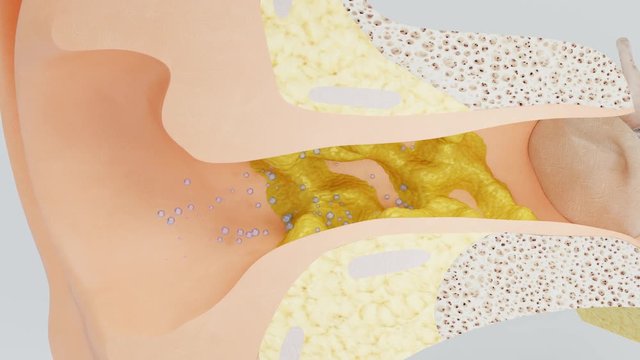 Ear wax swells at high humidity. 