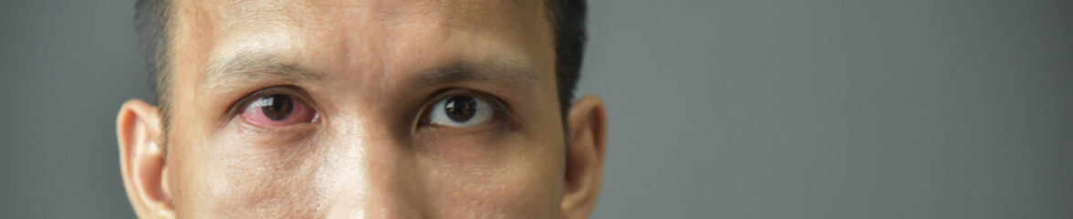 Irritated red bloodshot male eye.