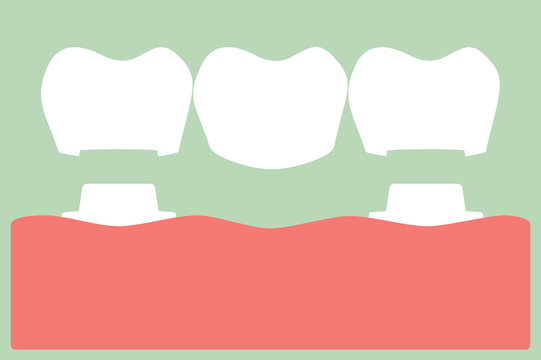 Dental Crown With Bridge, Installation Process And Change Of Teeth