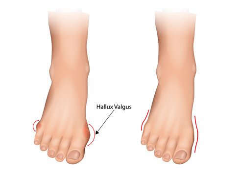 Illustration of the normal foot and hallux valgus. Human foot deformity. Hallux valgus and tailors bunion.