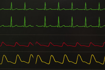 Monitoring displays of patient vital signs