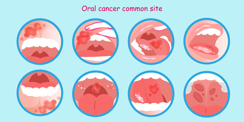 oral cancer commom site