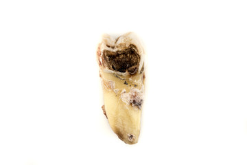 Decayed Tooth Isolated on White Background