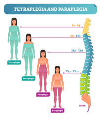 Tetraplegia and paraplegia spinal neural disorder medical vector illustration diagram with female patient and back bone cross section scheme.