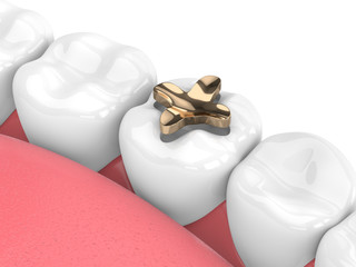 3d render of teeth with dental inlay golden filling