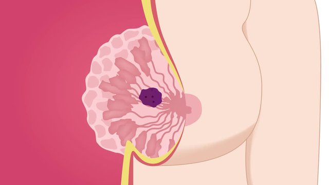 breast cancer graphic animation