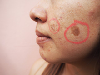 woman face with skin problems, melasma, acne scar, skin problems concept