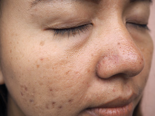 Close up the face has skin problem as same as melasma, dark circles and freckle.