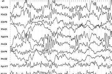 Brain wave patterns on electroencephalogram, EEG of the pediatric patients, problems in the electrical activity of the brain.