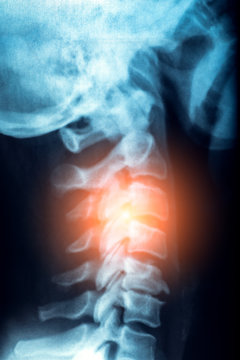 X-Ray or MRI of human neck with red zone of pain and stress in spine or vertebrae, trauma and rheumatism concept