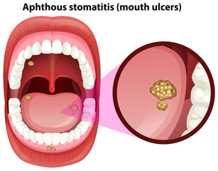Human Mouth Anatomy of Ulcers