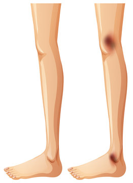 Human Legs and Bruise on White Background