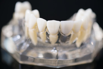 implant and orthodontic model for student to learning teaching model showing teeth.