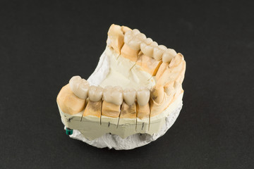 Fototapeta na wymiar cermet dental bridges