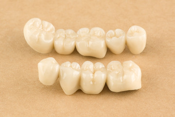 cermet dental bridges