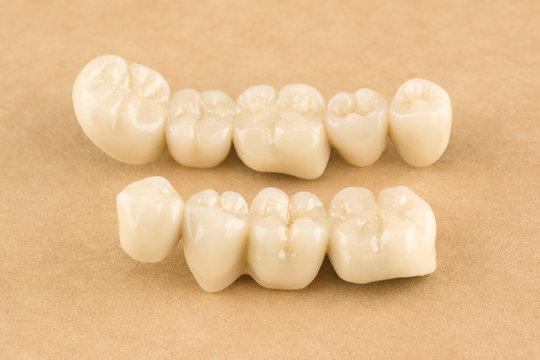 cermet dental bridges