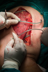 Breast cancer surgery in operating room