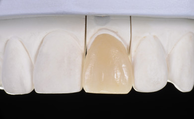 Veneer auf dem Modell