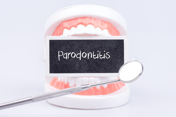 Parodontitis beim Zahnarzt