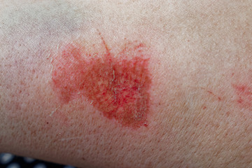 Fototapeta premium Scratched skin on arm