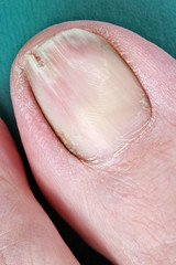 A sick cracked dirty old man's big toe nail