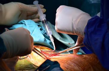 Doctor is ripping out saphenous vein to use as bypass graft in coronary artery bypass graft...
