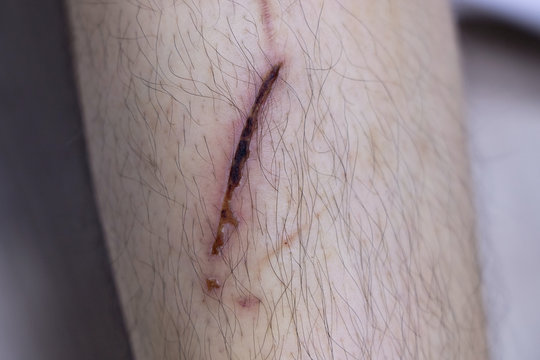 dried crust from wound on human leg