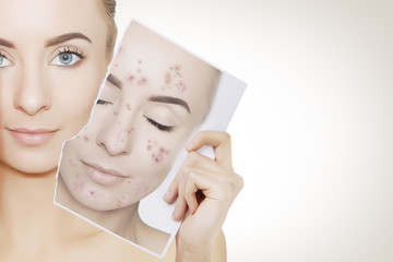 portrait of woman with clean skin holding portrait with pimpled skin