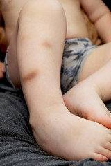 Bruises on the legs of the boy